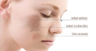 Tổn thương sắc tố da khiến bạn bị nám, tàn nhang hoặc đốm nâu