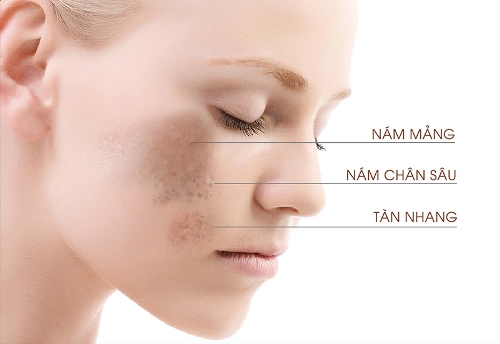 Tổn thương sắc tố da khiến bạn bị nám, tàn nhang hoặc đốm nâu