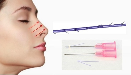 Nâng mũi bằng chỉ là phương pháp này còn gọi nâng mũi không phẫu thuật