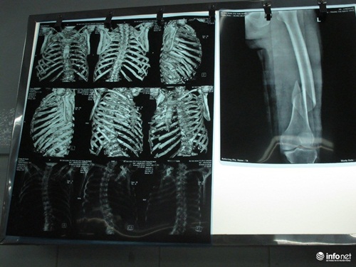 Xương sườn và xương đùi bệnh nhân bị gãy. Hình ảnh chụp bằng phim X-quang