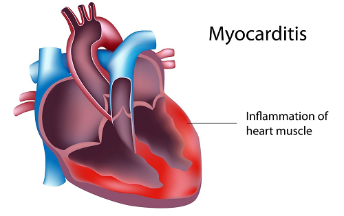 Viêm cơ tim gây nhiều biến chứng vô cùng nguy hiểm cho trẻ