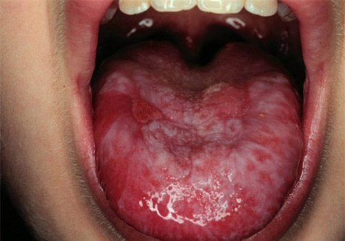 Hình ảnh ung thư miệng