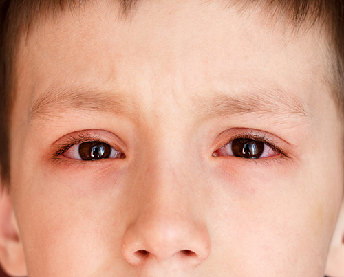 Đau mắt đỏ là bệnh thường gặp và rất phổ biến đặc biệt vào mùa mưa