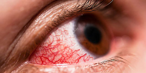 Dấu hiệu của bệnh là mắt đỏ lên, đặc biệt với trẻ nhỏ có thể kèm theo tình trạng sốt nhẹ