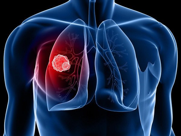 Ung thư phổi có tỷ lệ tử vong cao