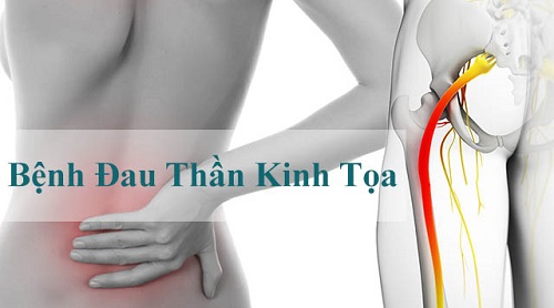 Bệnh đau thần kinh tọa thường gặp ở người cao tuổi